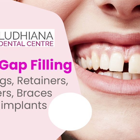 Dental Gap Filling – Bondings, Retainers, Veneers, Braces and implants