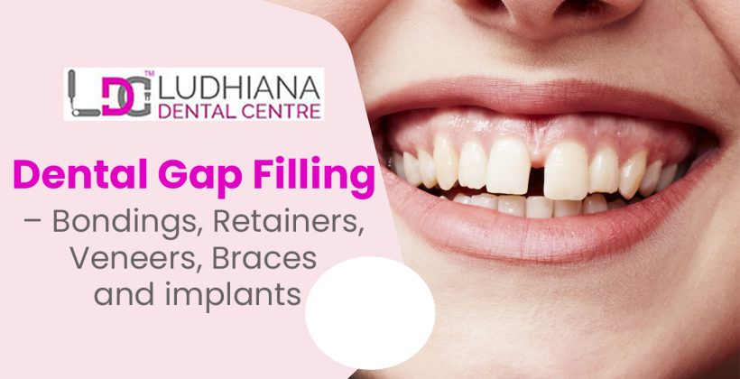 Dental Gap Filling – Bondings, Retainers, Veneers, Braces and implants