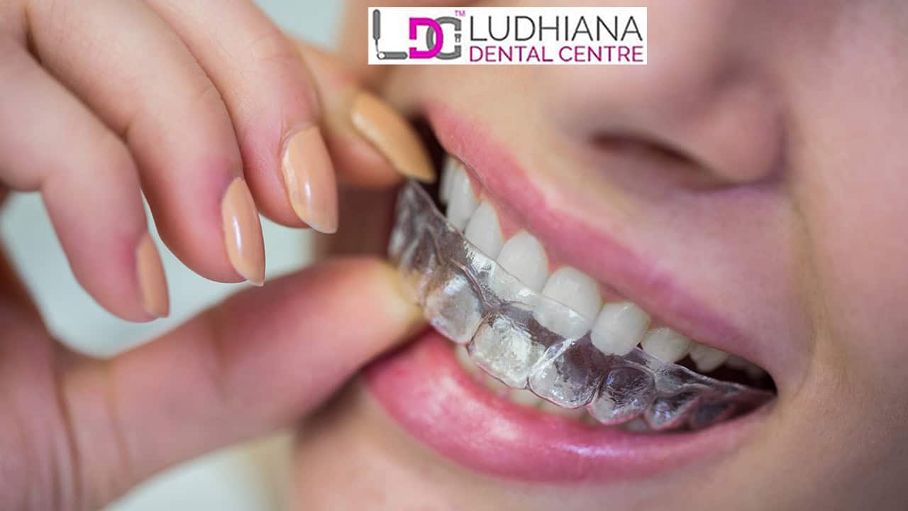 Do Invisible Braces Hurt? Comfort & Adjustment Explained
