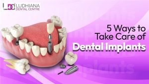 3D illustration of a human jaw with dental implants and artificial teeth