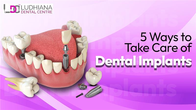 3D illustration of a human jaw with dental implants and artificial teeth